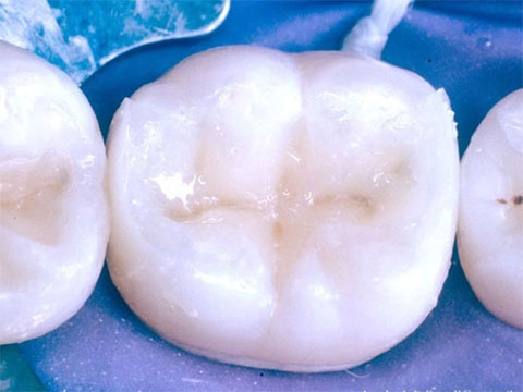 Conosci le differenze fra le otturazioni Studio dentistico Roma Rizzo Dott.ssa Sonia la Volpe 
