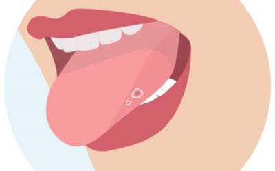 Le Afte della bocca Come curarle
