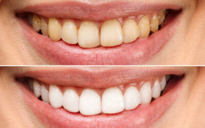 Sbiancamento Denti