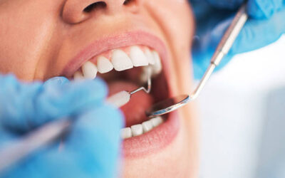 Granuloma denti: cura, terapie, sintomi e cause