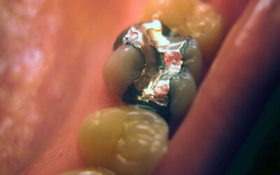 Otturazioni in Amalgama cosa c’è da sapere