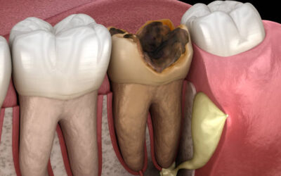 Granuloma e Cura canalare: un’ urgenza odontoiatrica