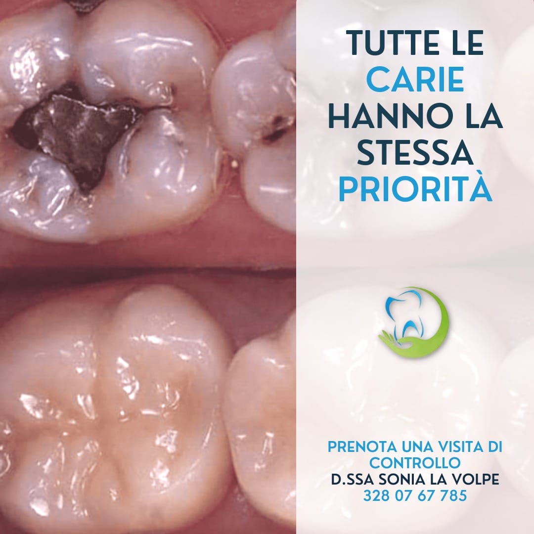 otturazioni amalgama prima dopo
