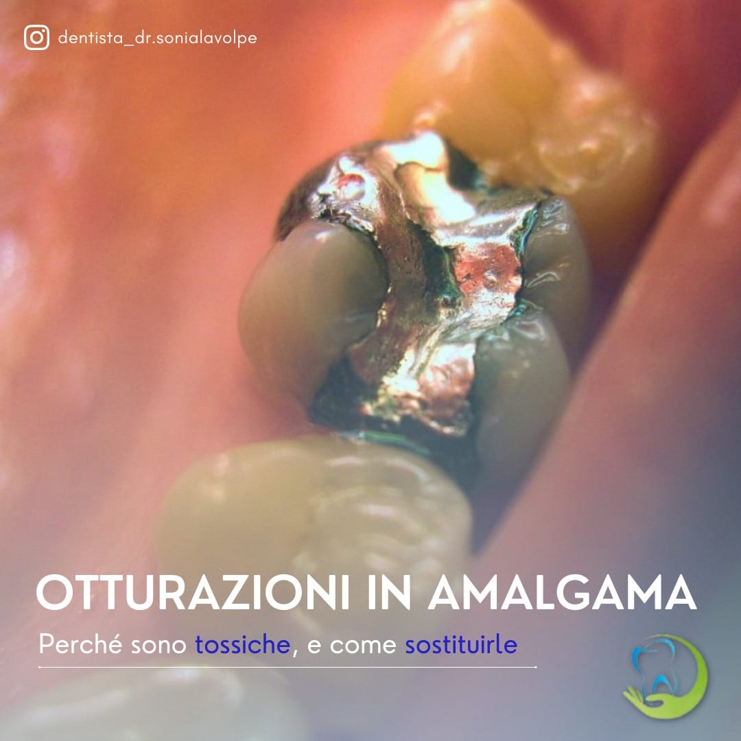otturazioni in amalgama